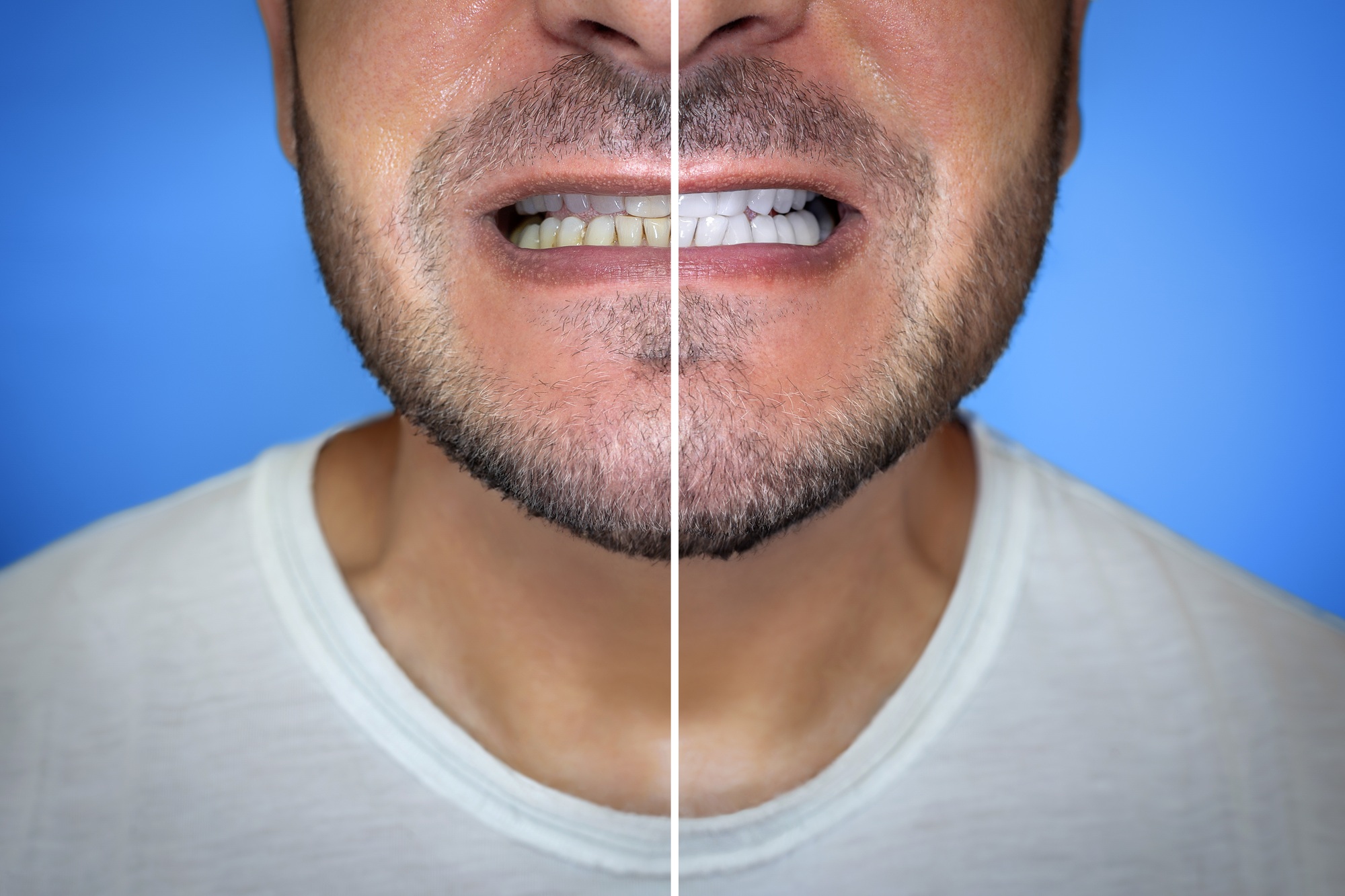 Close-up of a man's mouth, before and after teeth care.